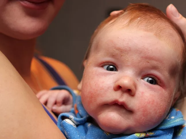 Az antibiotikumok ekcémát okozhatnak