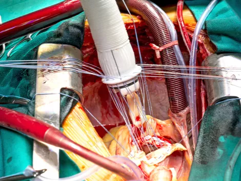 A fluorokinolonok növelik az aortaaneurizma rizikóját