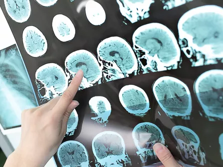 „Chemobrain” nehezíti a mellrákos betegek életét