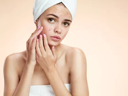 Az USA-ban vény nélkül is kapható lesz retinoid-tartalmú készítmény