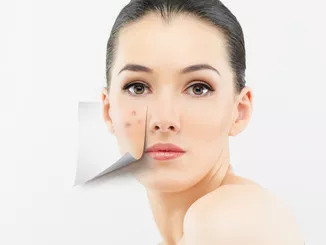 Az acne kezelése szisztémás antibiotikumokkal