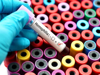 Kipróbálás alatt a hemofília A génterápiás gyógyítása