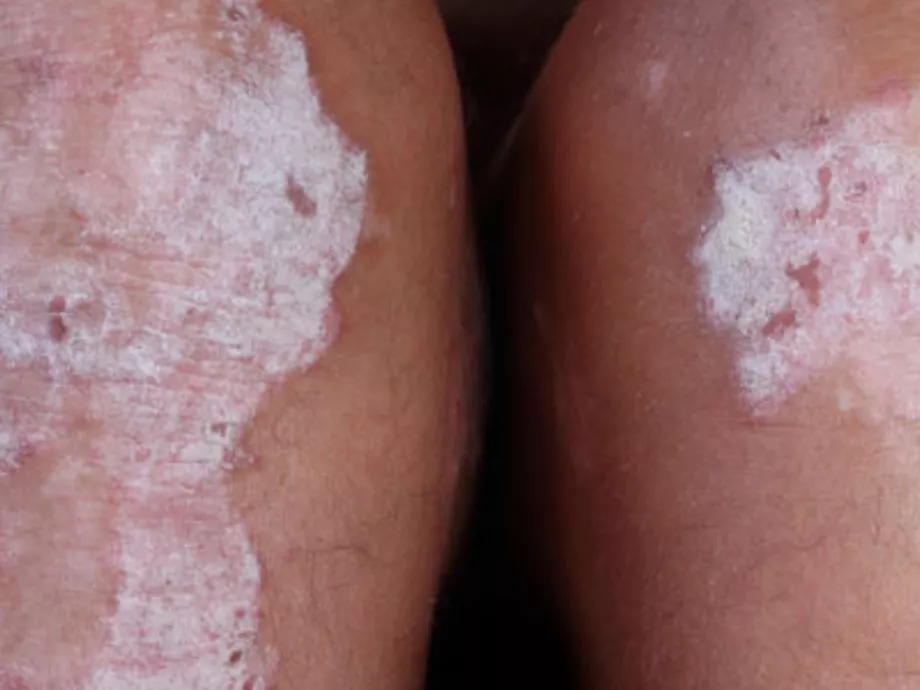 Krizaborol atópiás dermatitisz hosszú távú kezelésében