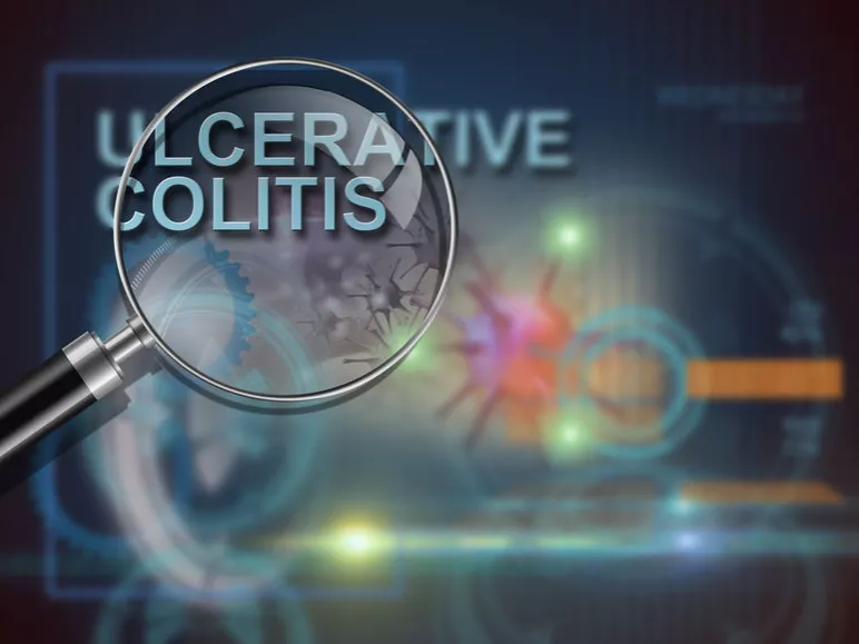 Minden harmadik colitis ulcerosa-s betegnél eredményes a széklettranszplantáció