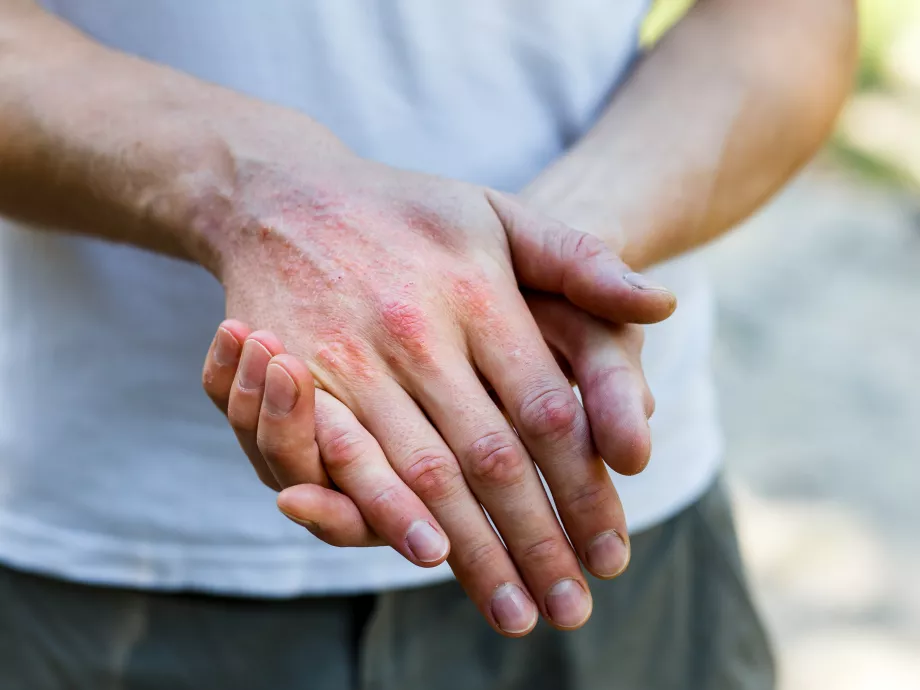 Interleukin-4 és atópiás dermatitisz: a patogenezistől a terápiáig