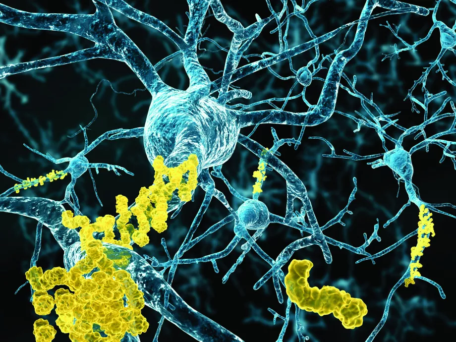 Szupramolekuláris gyógyszert vetnek be az Alzheimer-kór ellen