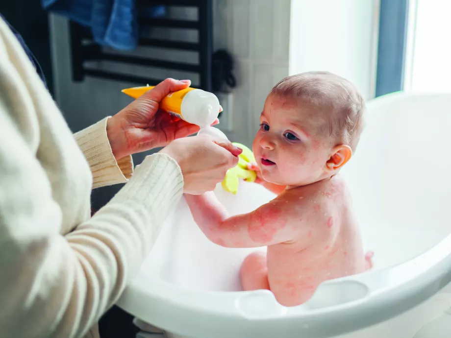 Emelkedő esetszámok: az atópiás dermatitisz a gyógyszertári gyakorlatban