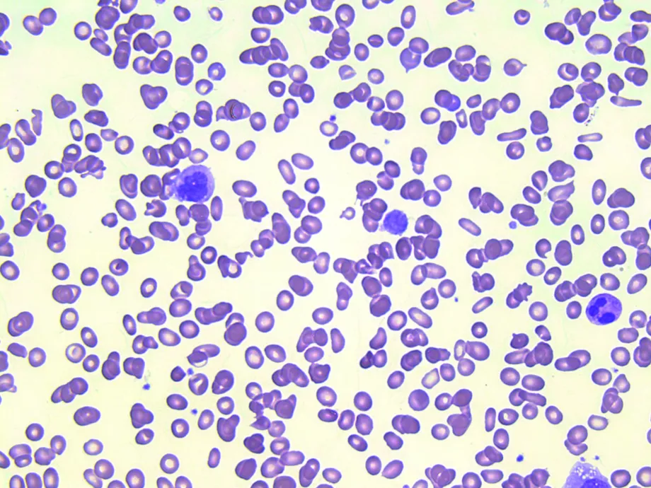 Primer myelofibrosis: diagnózis, kockázatbesorolás, kezelés