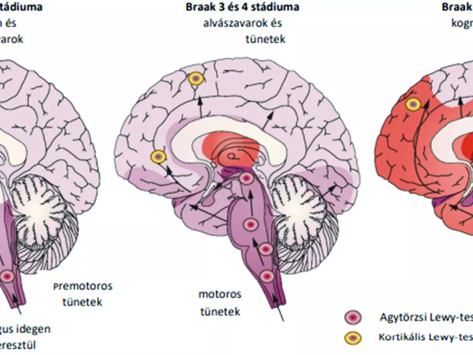 A Parkinson-kór klinikai stádiumai
